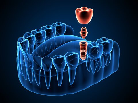 3. Implant Dentistry and Oral Rehabilitation