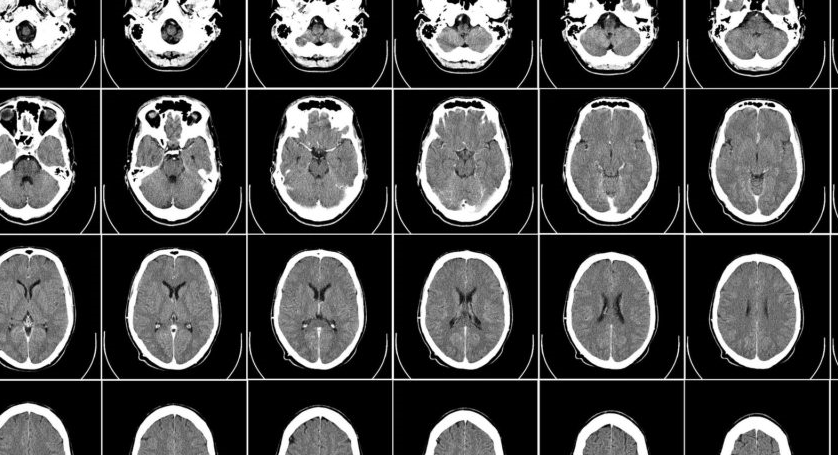 Neuro-oncology & Brain Tumor Research